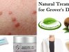 7 Natural Remedies For Grover?s Disease Treat With Neem Leaves