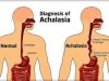 How To Get Rid Of Achalasia At Home With Nutrients And Essential Oils