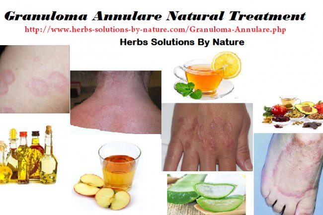 7 Effective Natural Treatments for Granuloma Annulare 