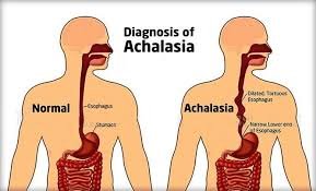 How To Get Rid Of Achalasia At Home With Nutrients And Essential Oils