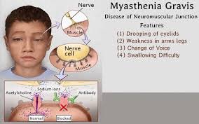 5 Natural Remedies For Myasthenia Gravis Easy Way To Change Your Lifestyle