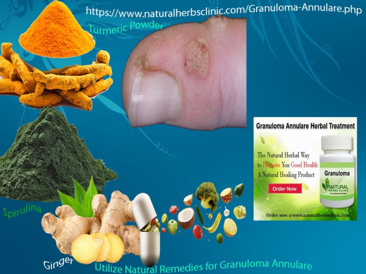 How Might Granuloma Annulare Be Treated With Home Remedies