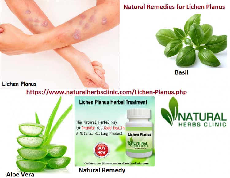 Make Use Of Natural Remedies For Lichen Planus Scars