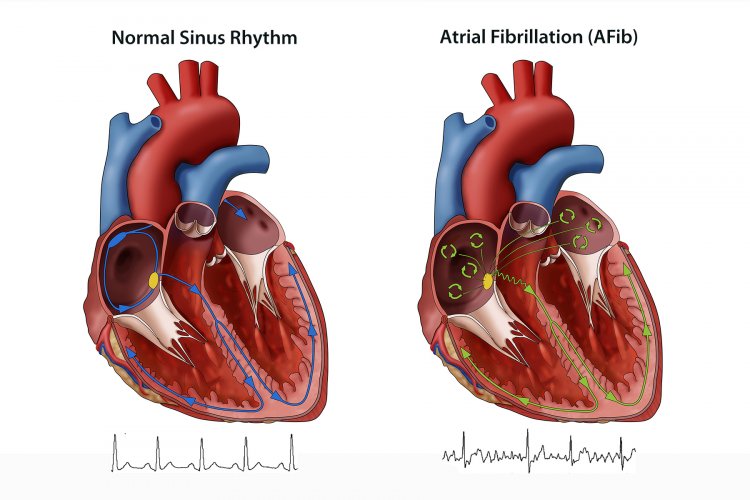 Best Natural Ways To Treat Atrial Fibrillation With Happy Lifestyle