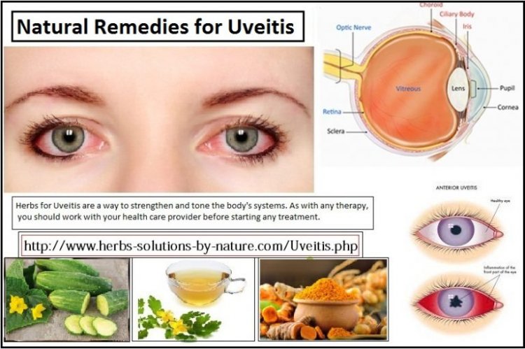 Natural Remedies for Uveitis with Precautions and Lifestyle Changes