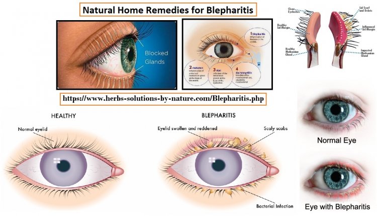 Natural Remedies for Blepharitis Treat with Natural Essential Oils