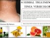 Natural Remedies for Tinea Versicolor with Helpful Home Ingredients