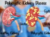 Natural Remedies for Polycystic Kidney Disease and Healthy Diet