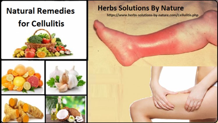 Natural Remedies for Cellulitis Treat with Natural Essential Oils