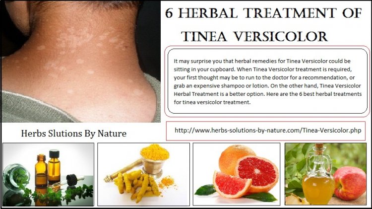 Natural Remedies for Tinea Versicolor with Helpful Home Ingredients
