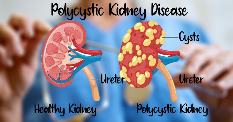 Natural Remedies for Polycystic Kidney Disease and Healthy Diet