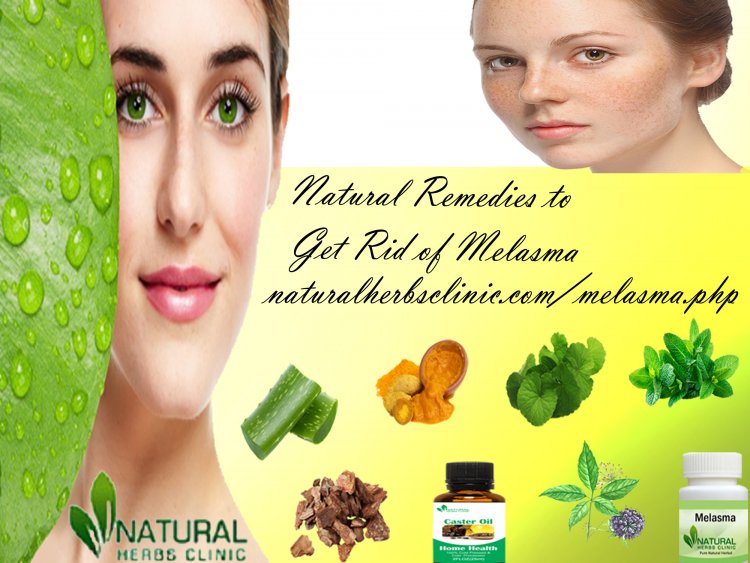 7 Natural Remedies to Get Rid of Melasma