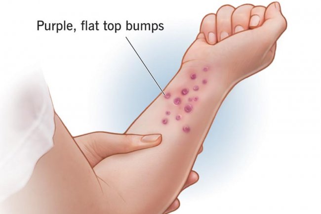 Top 10 Herbal Treatments for Lichen Planus You Need to Try!