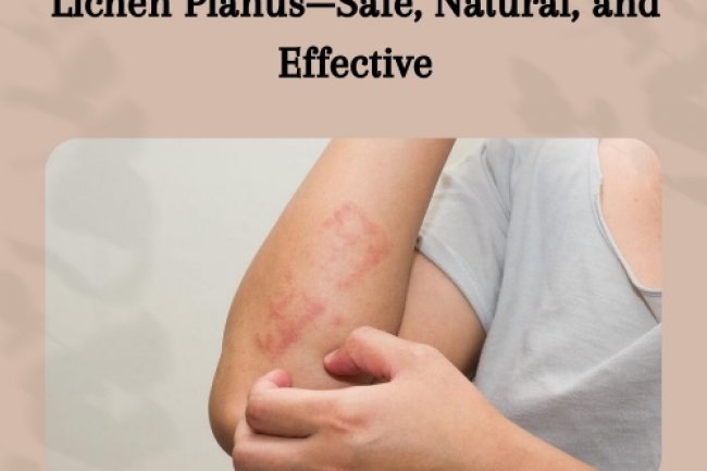 Doctor-Approved Supplements for Lichen Planus—Safe, Natural, and Effective