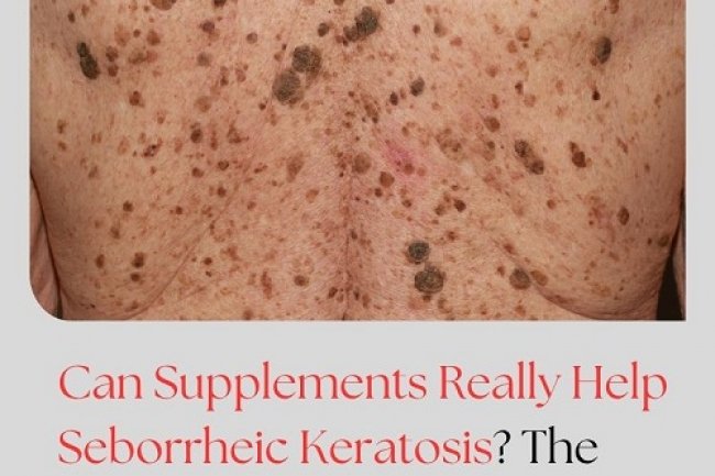Can Supplements Really Help Seborrheic Keratosis? The Answer May Surprise You