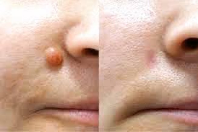 The Truth About Skin Growths: What’s Harmless and What’s Not