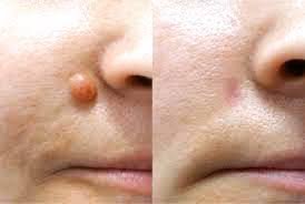 The Truth About Skin Growths: What’s Harmless and What’s Not