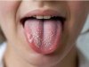 Top 10 Remedies for Oral Lichen Planus You Can Try Today