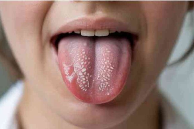 Top 10 Remedies for Oral Lichen Planus You Can Try Today