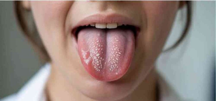 Top 10 Remedies for Oral Lichen Planus You Can Try Today